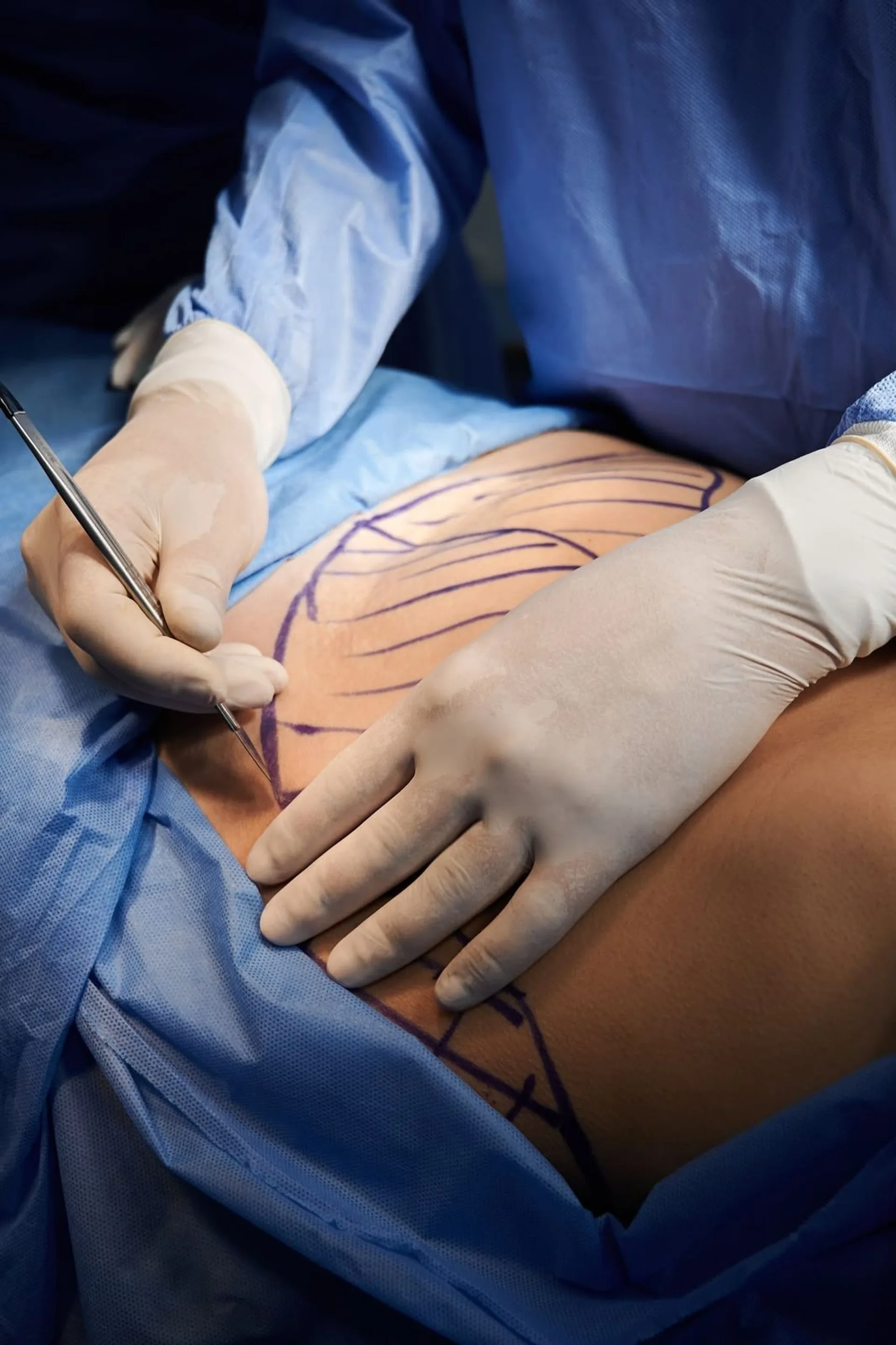 Une incision tracée avant une opération, champ opératoire